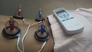  Electronic Cupping