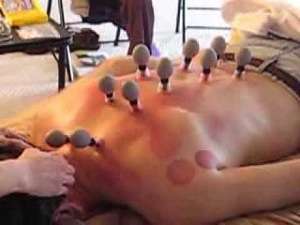 Magnetic Cupping