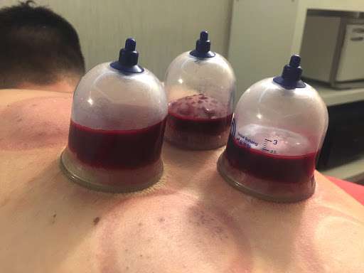  wet (Hijama) Cupping Therapy