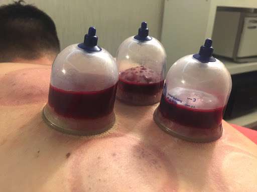 wet (Hijama) Cupping Therapy