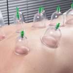 Acupuncture Fire cupping detail on man's back; Shutterstock ID 285433880; PO: aol; Job: production; Client: drone