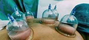 Water Cupping