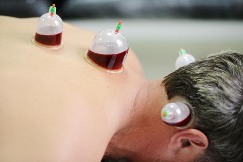 CUPPING THERAPY: a sneak peek into my personal experience