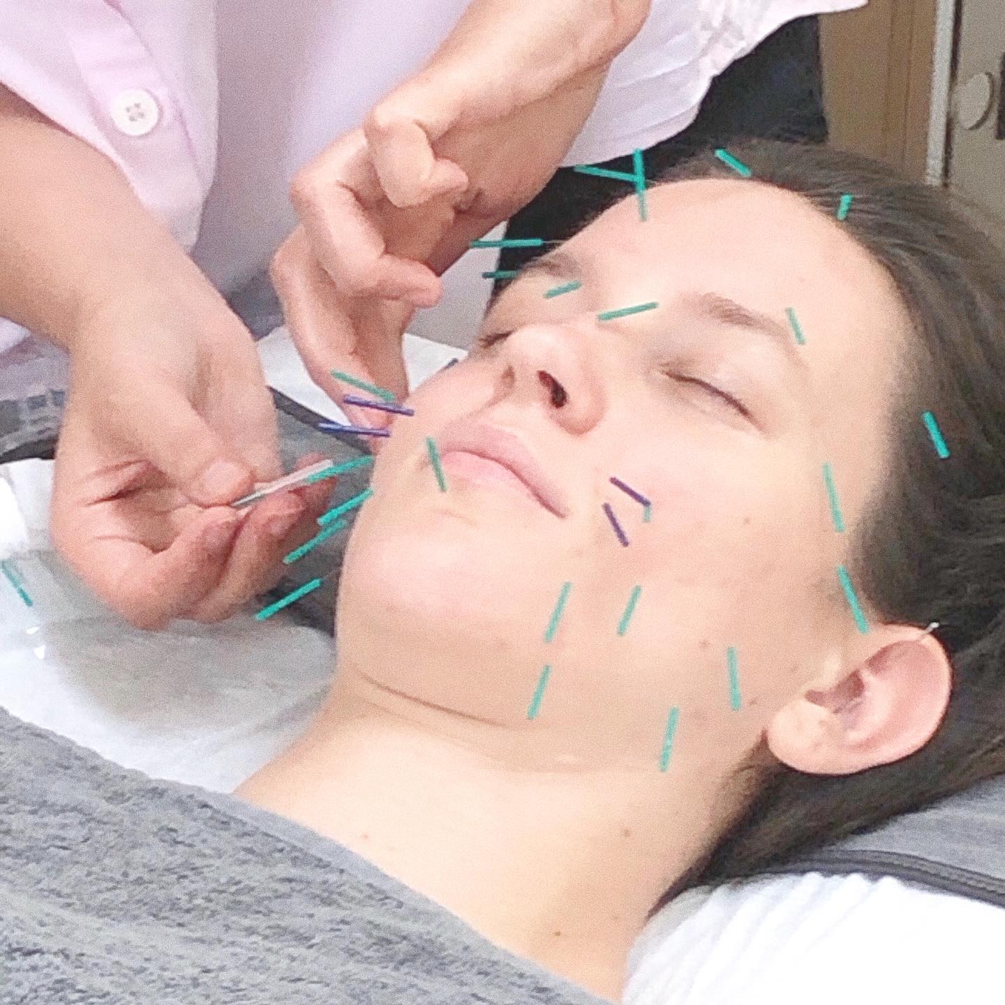 Advanced Acu-facial therapy with Cosmetic Acupuncture